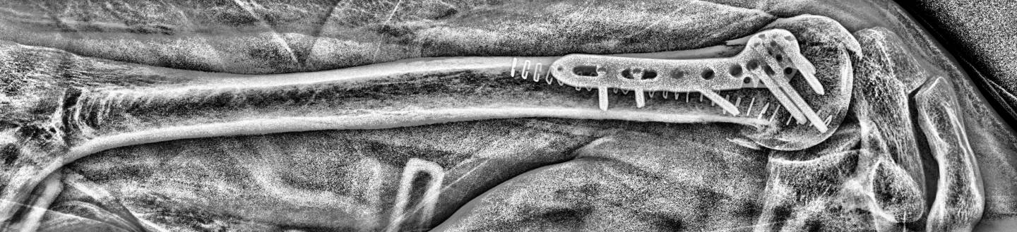 A shoulder injured through Crom-Fu. Humoral head fracture, open reduction and internal fixation using an adamantium plate.