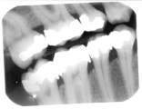 Dental X-ray film.